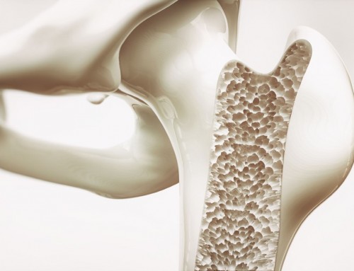 Οστεοπόρωση: Πάρτε μέτρα για την υγεία των οστών σας