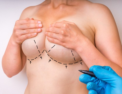 Γυναικείο στήθος: Πλεονεκτήματα νέων τεχνικών ανόρθωσης στήθους
