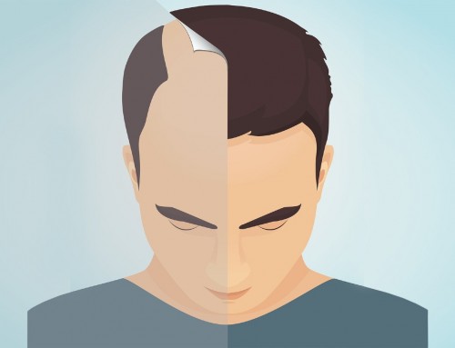 Οι τέσσερις πιο διαδεδομένοι μύθοι για τη μεταμόσχευση μαλλιών