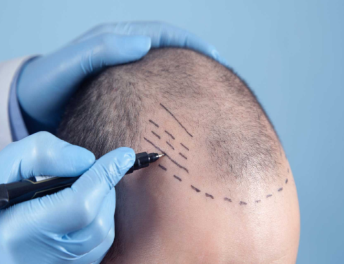 Τριχόπτωση: Σε ποιους ενδείκνυται η μεταμόσχευση μαλλιών;